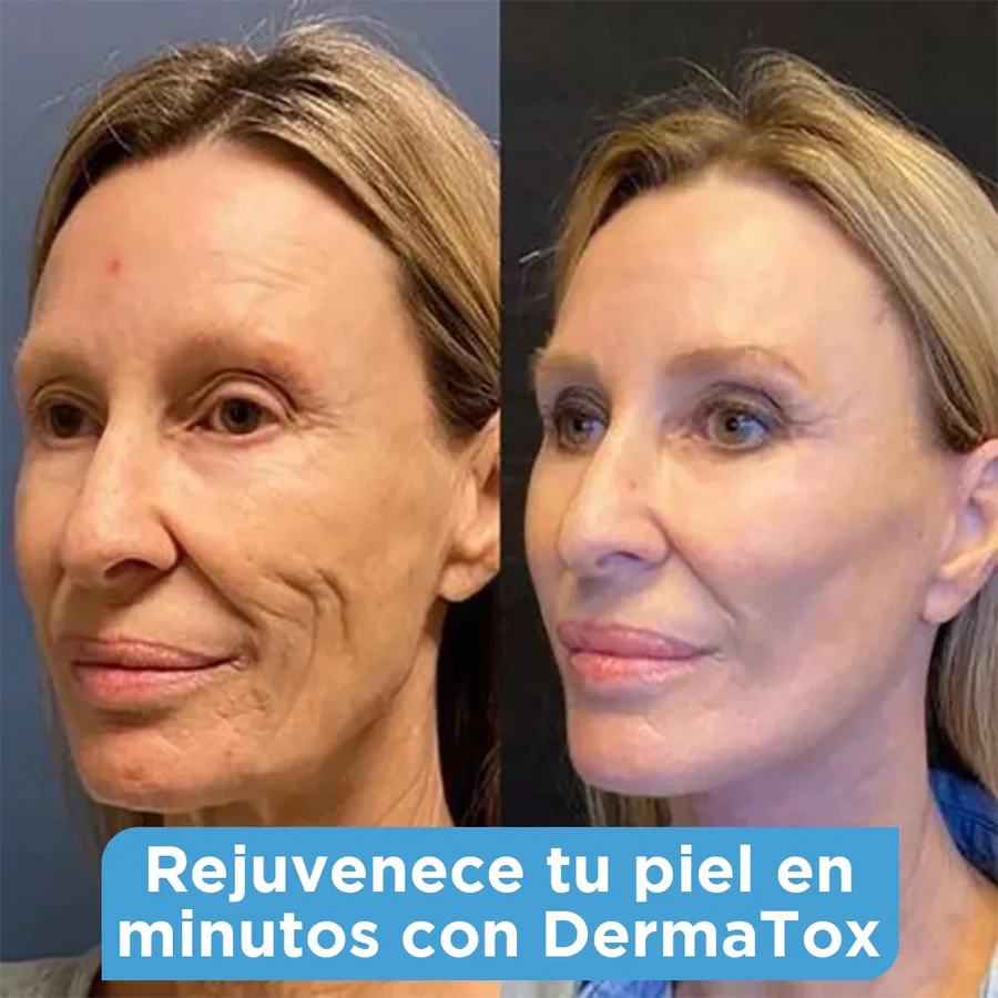 ¿Fórmula Mágica para Arrugas? Conoce DermaTox –Rejuvenecimiento Sin Agujas!