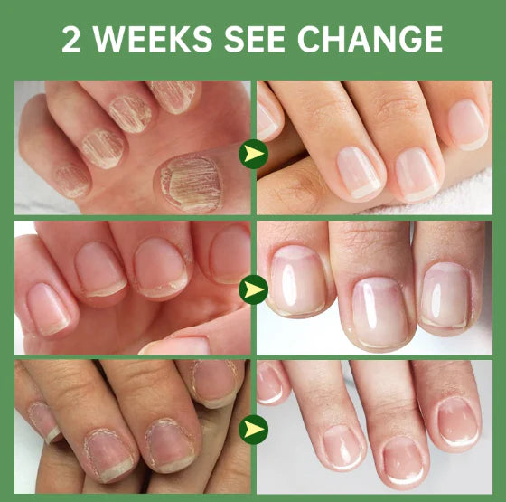 (COMPRA 1 LLEVA 2) 7 Days - Base Uñas 4K +Potente🙅♀️ +Crecimiento & Hongos AVANZADO 300%