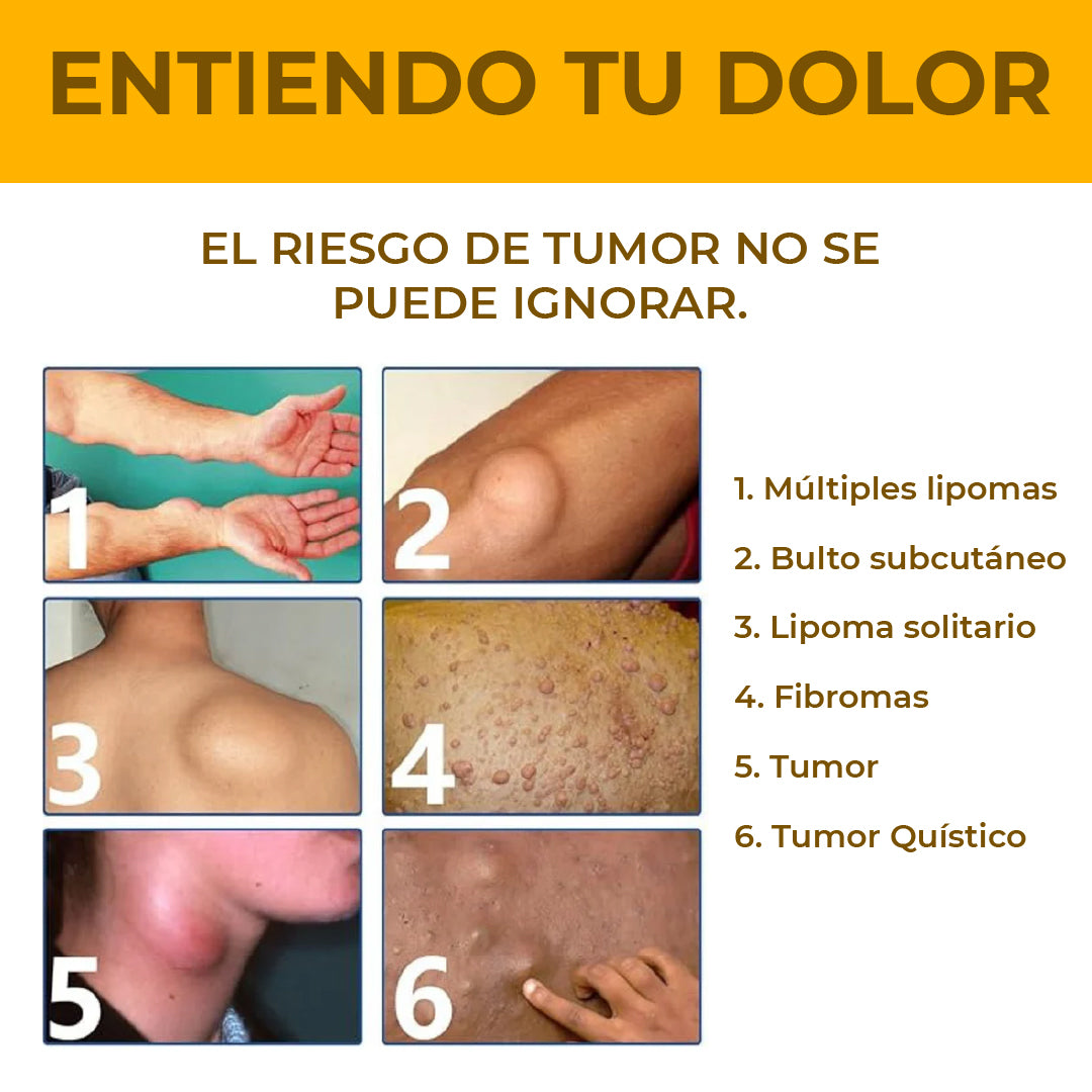 EELHOE® LIPOMA - CREMA REDUCTORA DE LIPOMAS