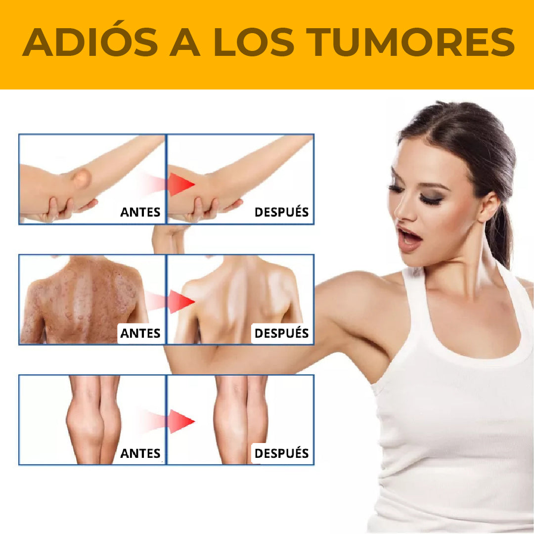 EELHOE® LIPOMA - CREMA REDUCTORA DE LIPOMAS