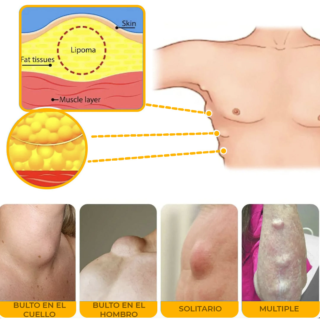 EELHOE® LIPOMA - CREMA REDUCTORA DE LIPOMAS