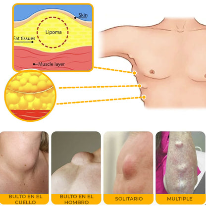 EELHOE® LIPOMA - CREMA REDUCTORA DE LIPOMAS