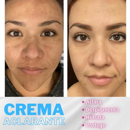 Alantoina Cream™ - Crema Aclarante